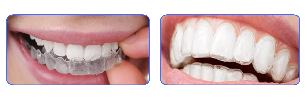 Invisible Braces/Aligners for Teeth
